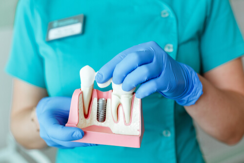 What are the advantages of dental implants