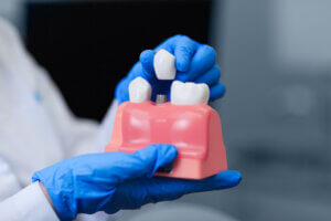 Why should I clean All-on-4 dental implants