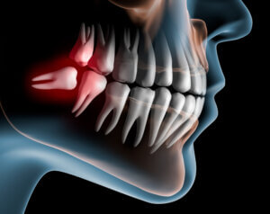 Who performs expertise-based wisdom teeth removal in Temecula, CA