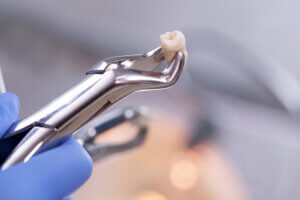 What causes emergency tooth extractions