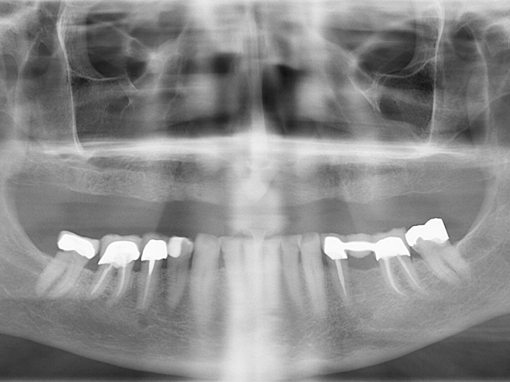 🥇 Dental Implants & Allon4 in Perris, CA