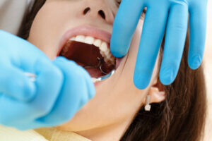 4 Common Problems Caused by Impacted Wisdom Teeth
