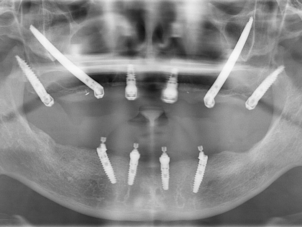 🥇 Dental Implants & Allon4 in Perris, CA