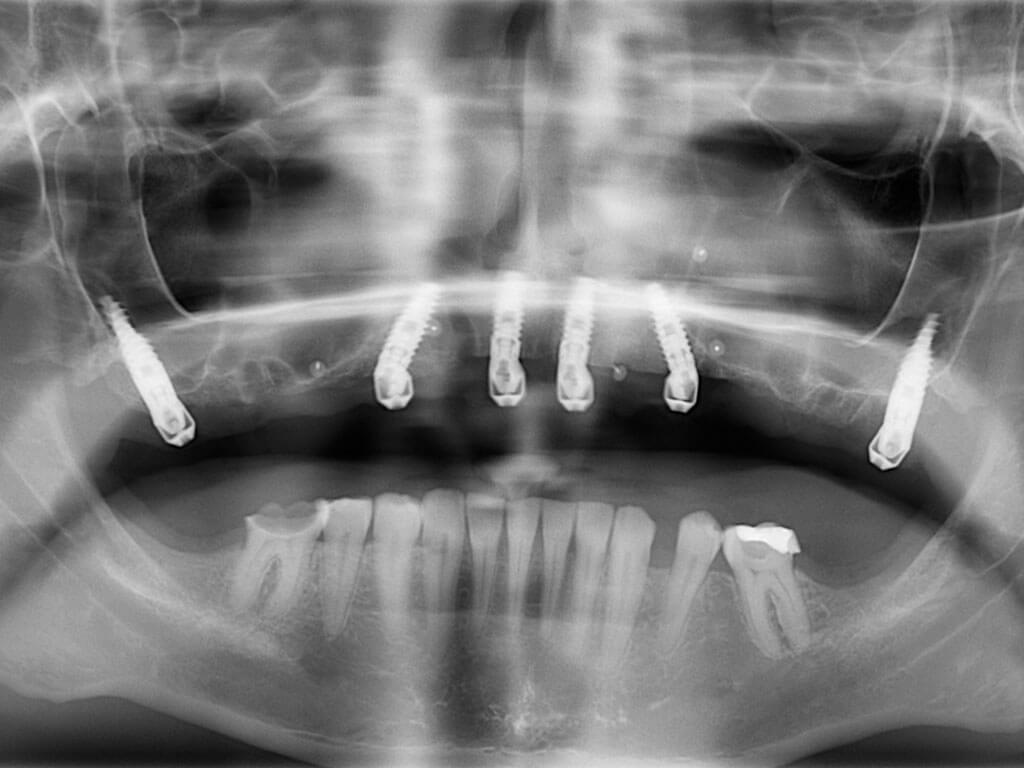 🥇 Dental Implants & Allon4 in Perris, CA