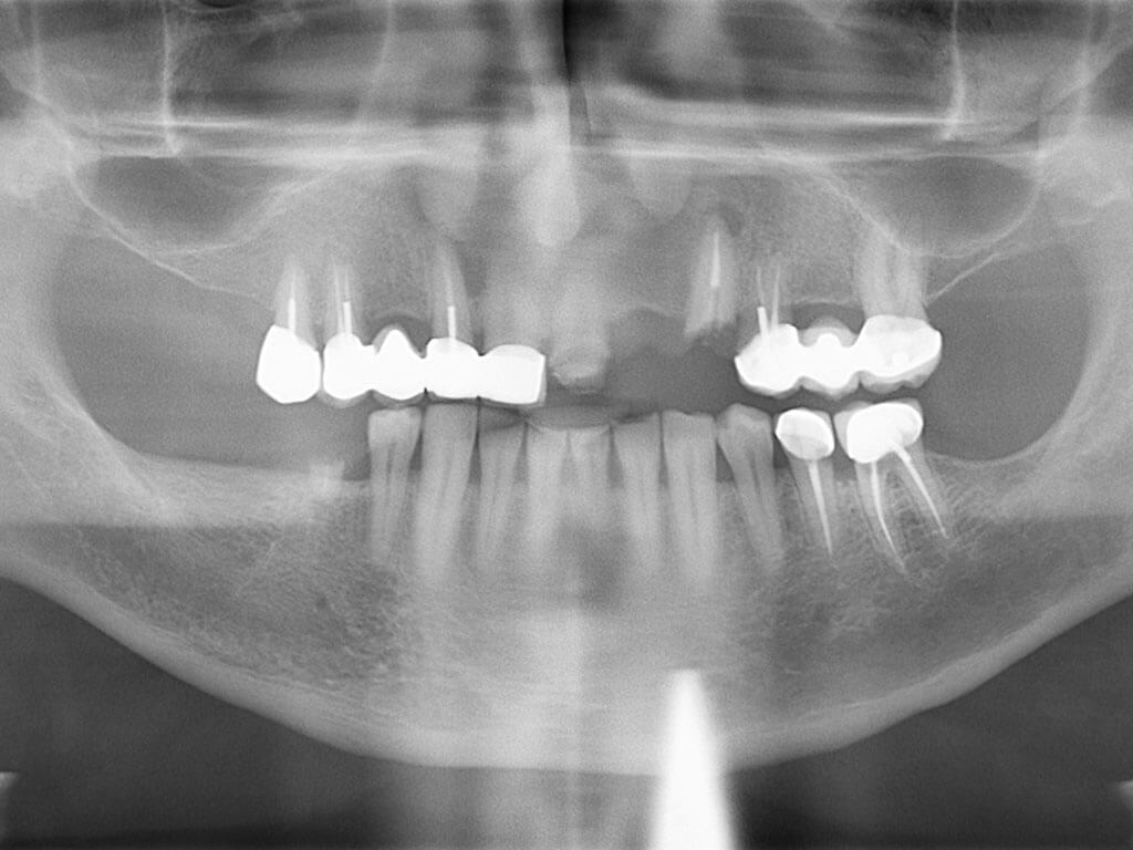 🥇 Dental Implants & Allon4 in Perris, CA