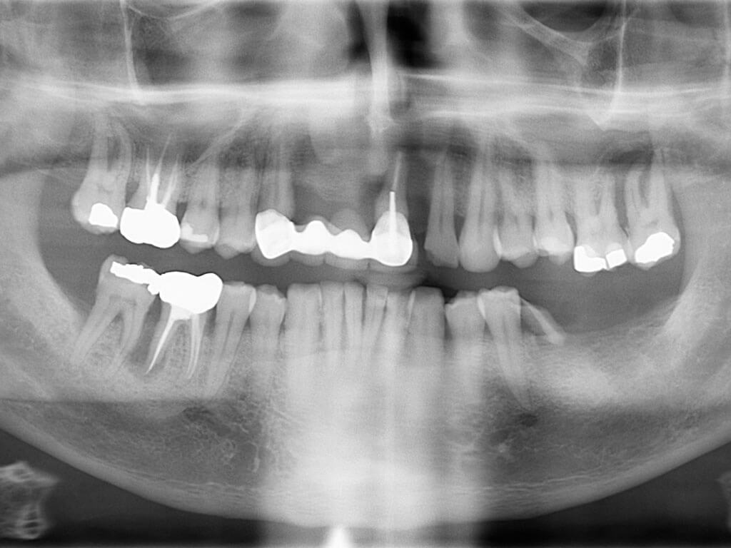 🥇 Dental Implants & Allon4 in Perris, CA