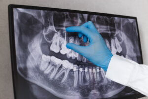 Do braces need to be removed for wisdom teeth removal