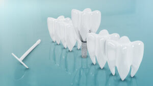 What should I know about dental implants?