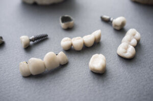 What is the history of dental implants?