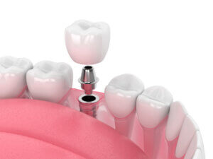 What-Does-a-Single-Tooth-Dental-Implant-Procedure-Include