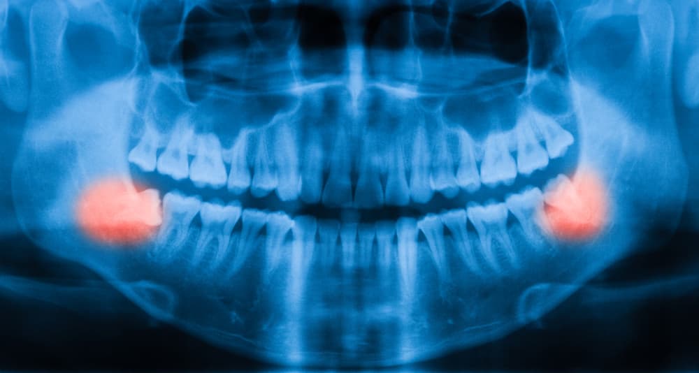 Wisdom Teeth Infection Explained Temecula Ca Wisdom Teeth Treatment