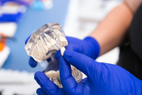 Traditional Dental Implants The Pros and Cons