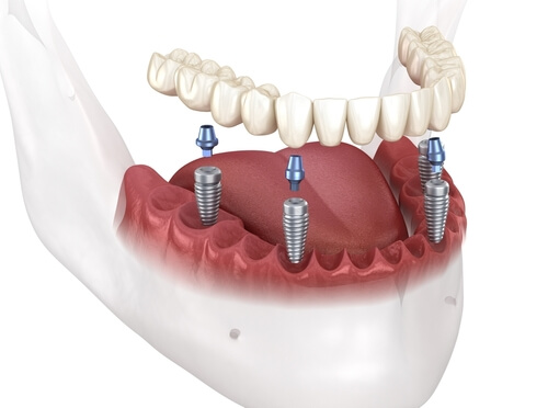 What do you need to know about all-on-4 dental implants