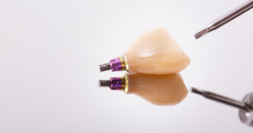 Do dental implants behave like natural teeth