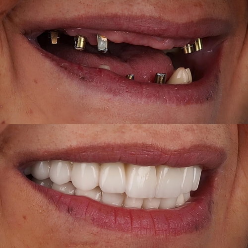 Will dental implants change how I speak