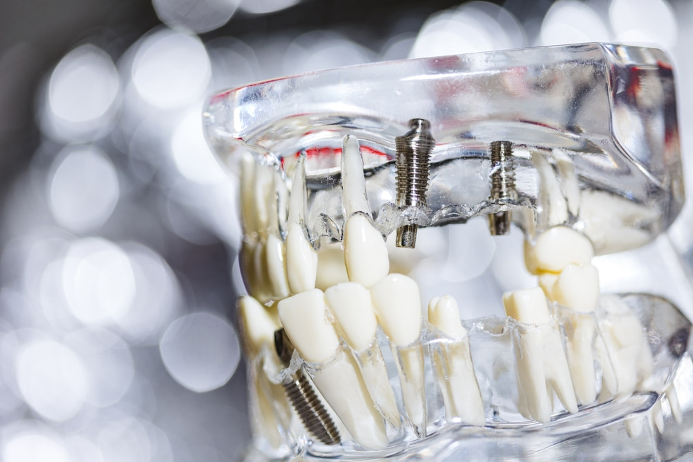 What are the common dental conditions that qualify patients for All-on-4 implants