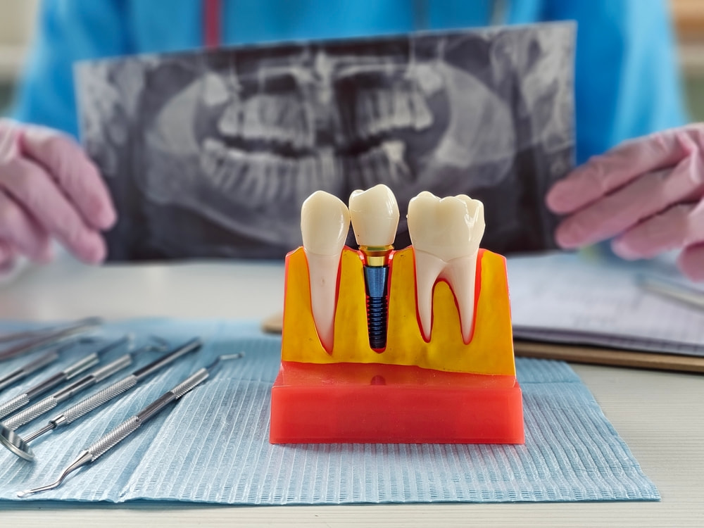 financing options all on 4 dental implants San Marcos