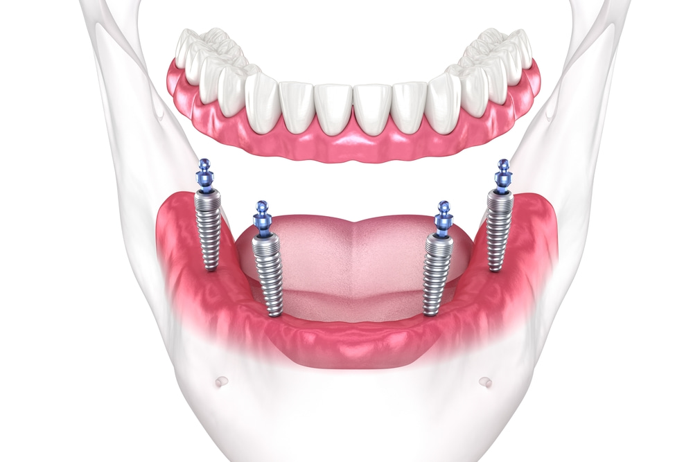 What happens during an implant consultation