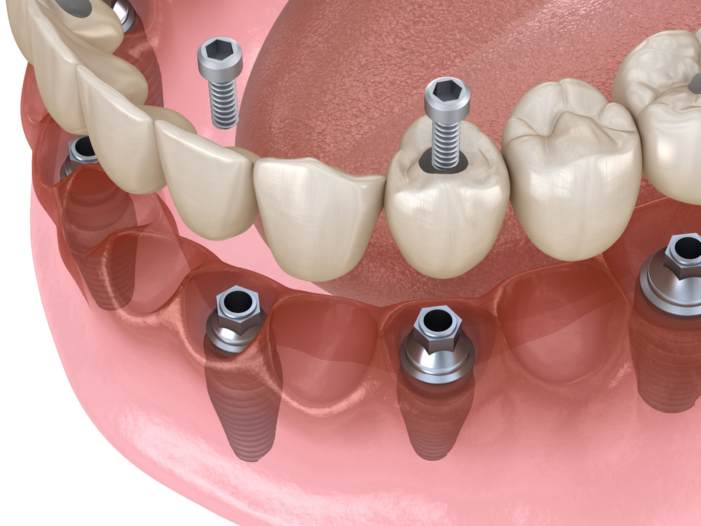 specialists in dental implants in Vista, CA