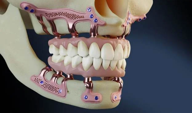 Can gum disease or smoking disqualify you from subperiosteal implants