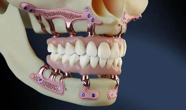 What is a subperiosteal implant