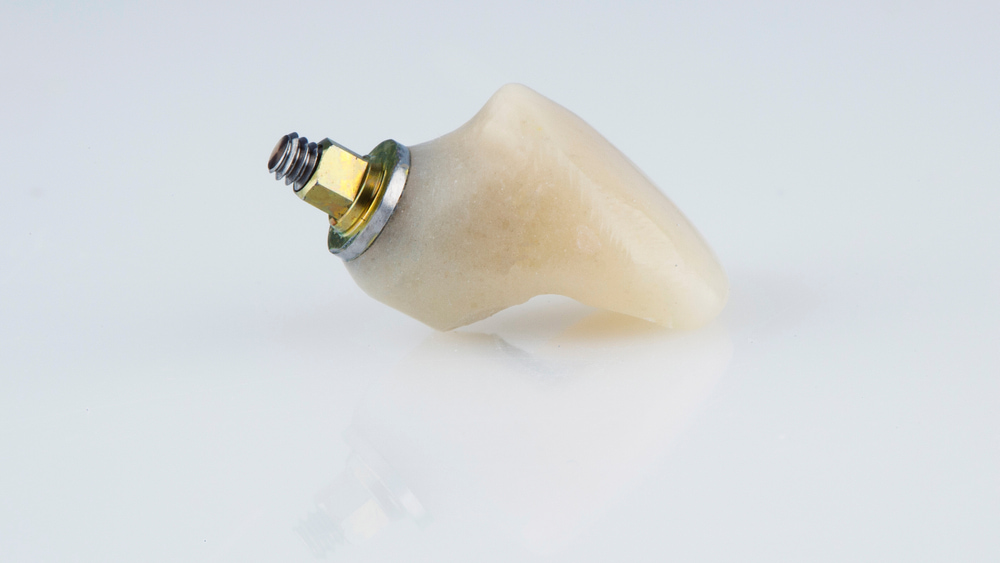 When is the final implant crown placed