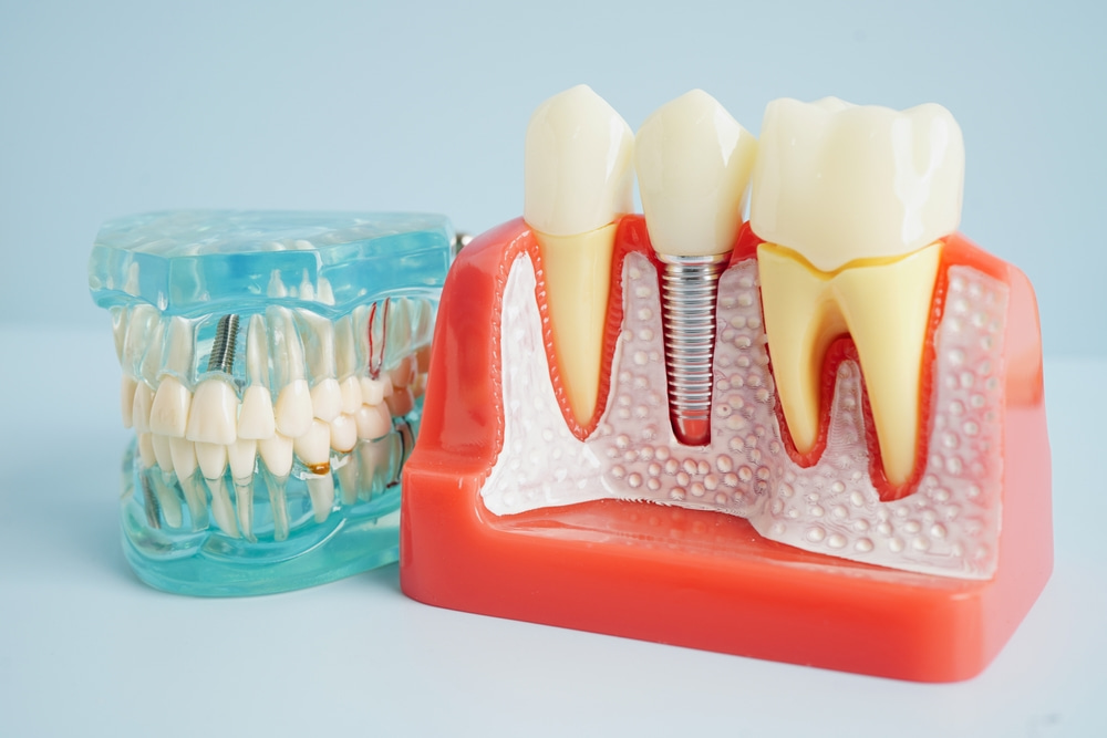 natural-looking mini dental implants in Oceanside, CA