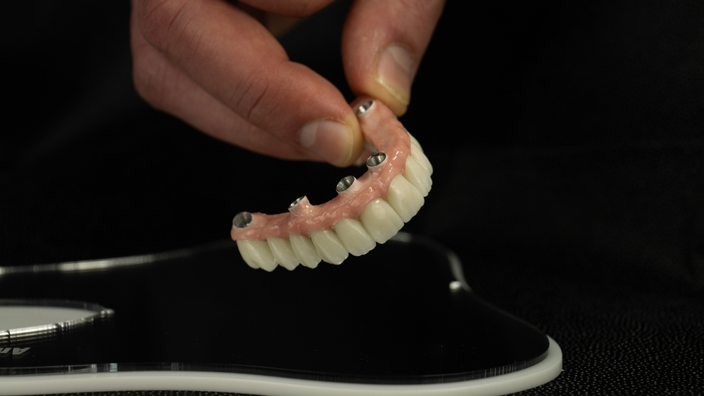 What is a bone spur after All-on-4 surgery