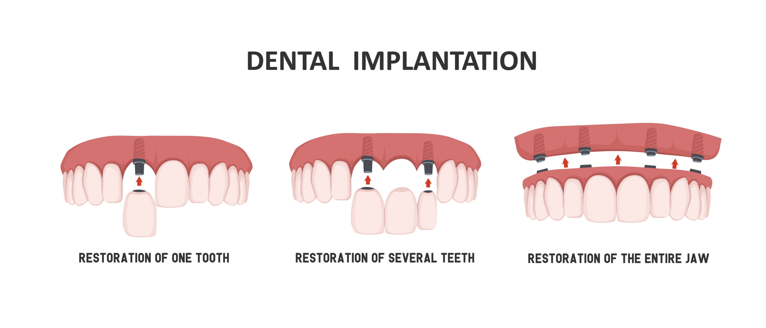 How long do All-on-X implants last
