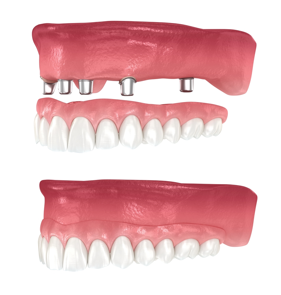 When are individual dental implants used